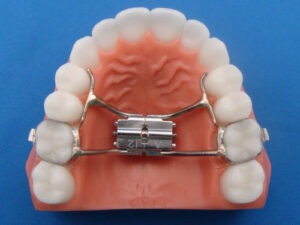 Upper Rapid Palatal Expander Specialty Appliances