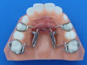 distal jet distalization Specialty Appliances