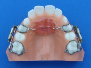 distalization rapid molar distalizer Specialty Appliances