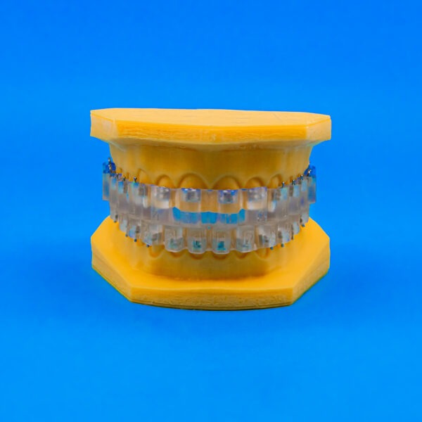 Printed 3D Indirect Bonding